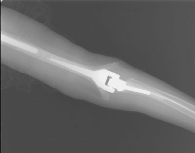 Solar Total Elbow Prosthesis (Implant 87)
